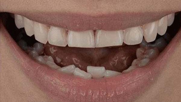 Before: porcelain veneers case 13