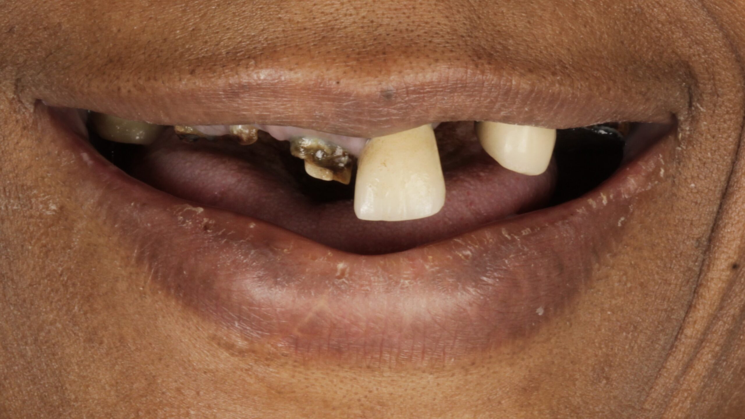 Before: double arch case 23