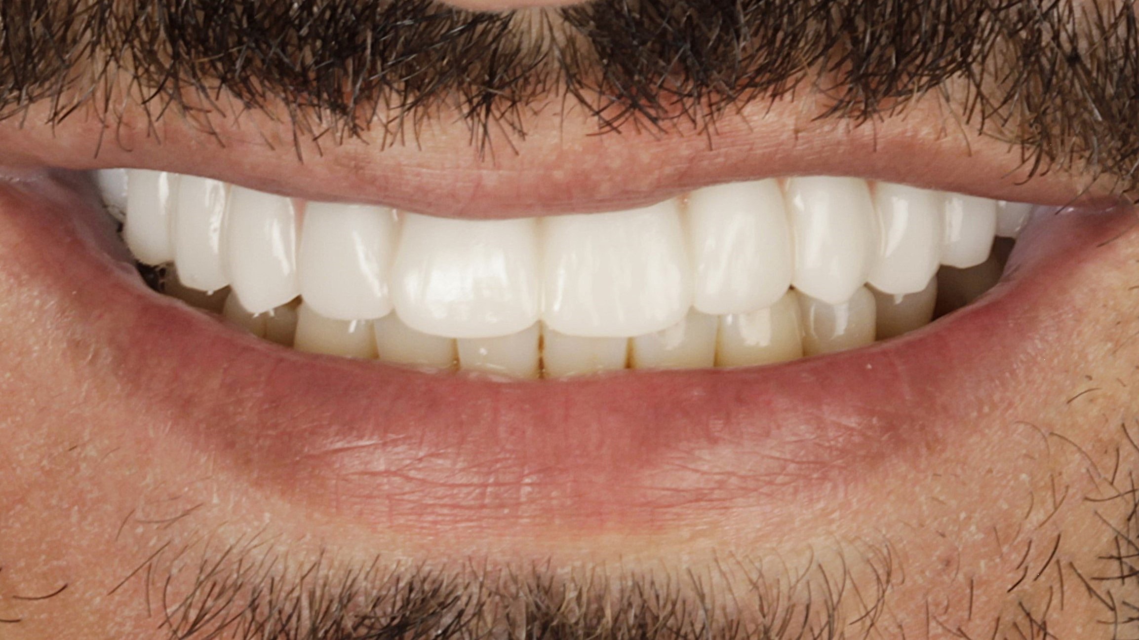 After: single arch case 41