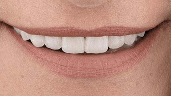 After: porcelain veneers case 15