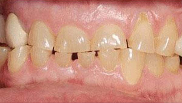 Before: porcelain veneers case 17