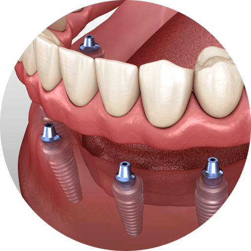 Illustration of a denture held on four dental implants in the jaw