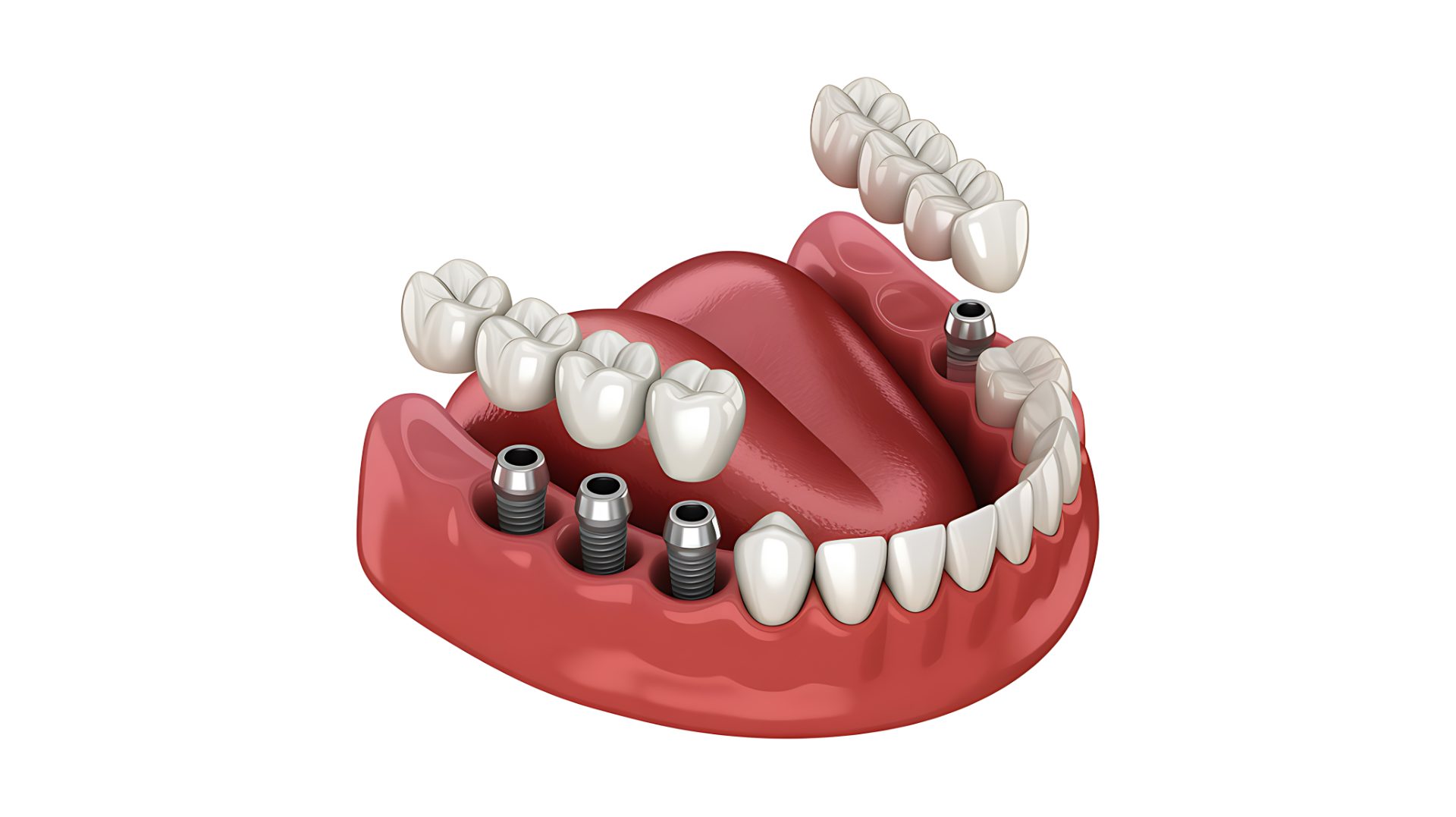 Illustration of implant-supported bridges lowered onto implant posts in a lower jaw model