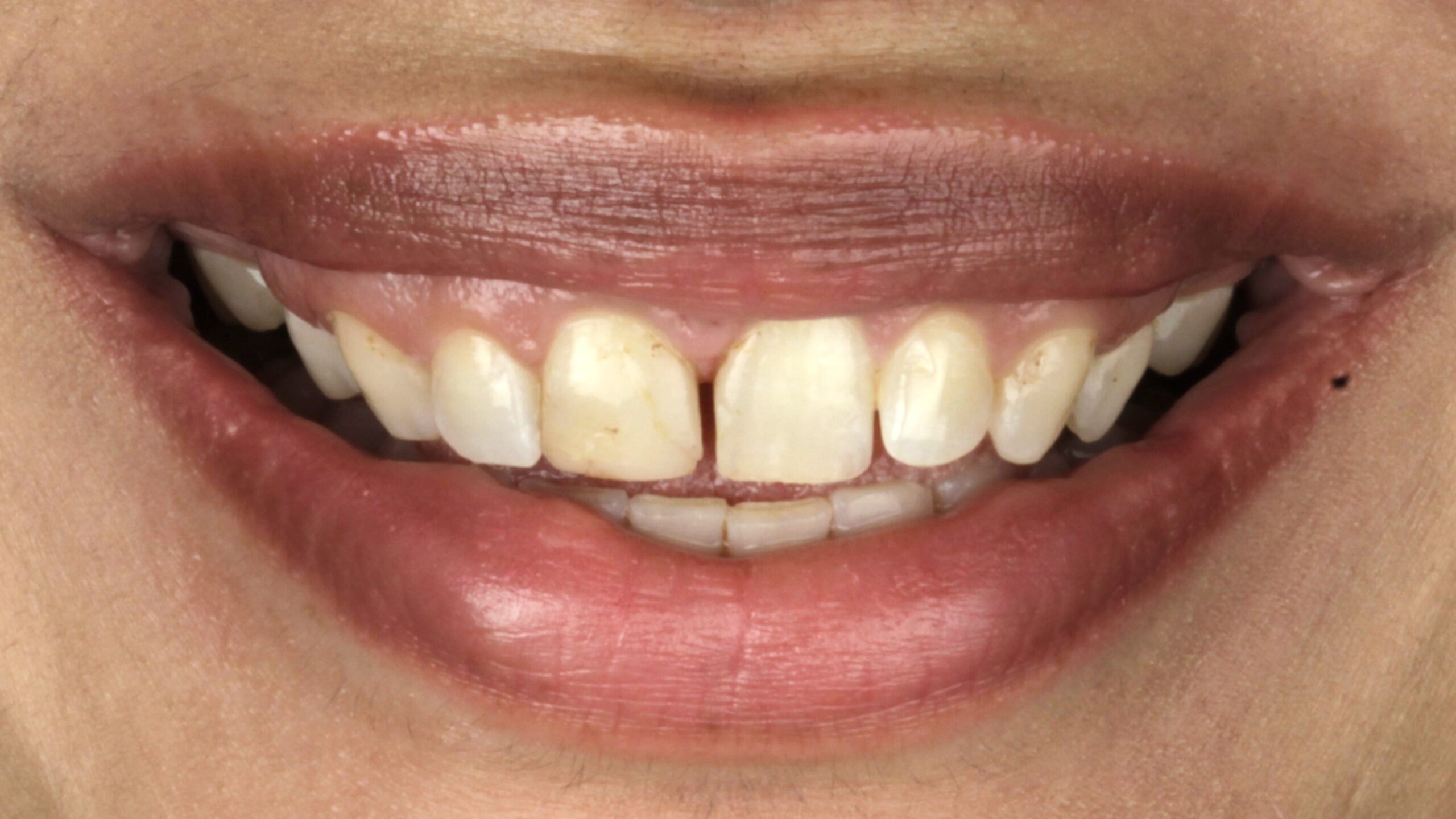 Before: porcelain veneers case 39