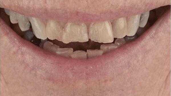 Before: porcelain veneers case 19
