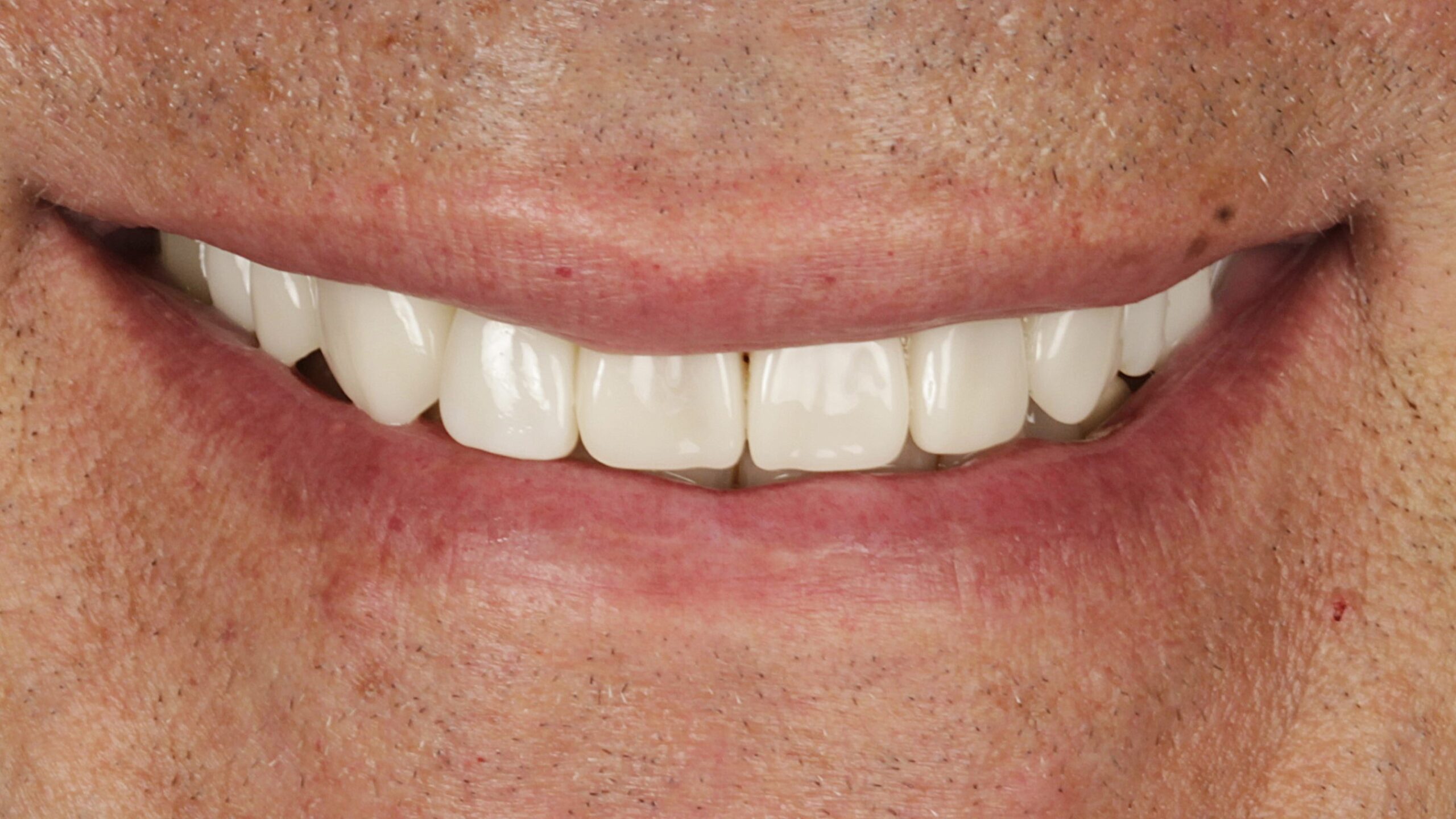 After: veneers and implant restoration case
