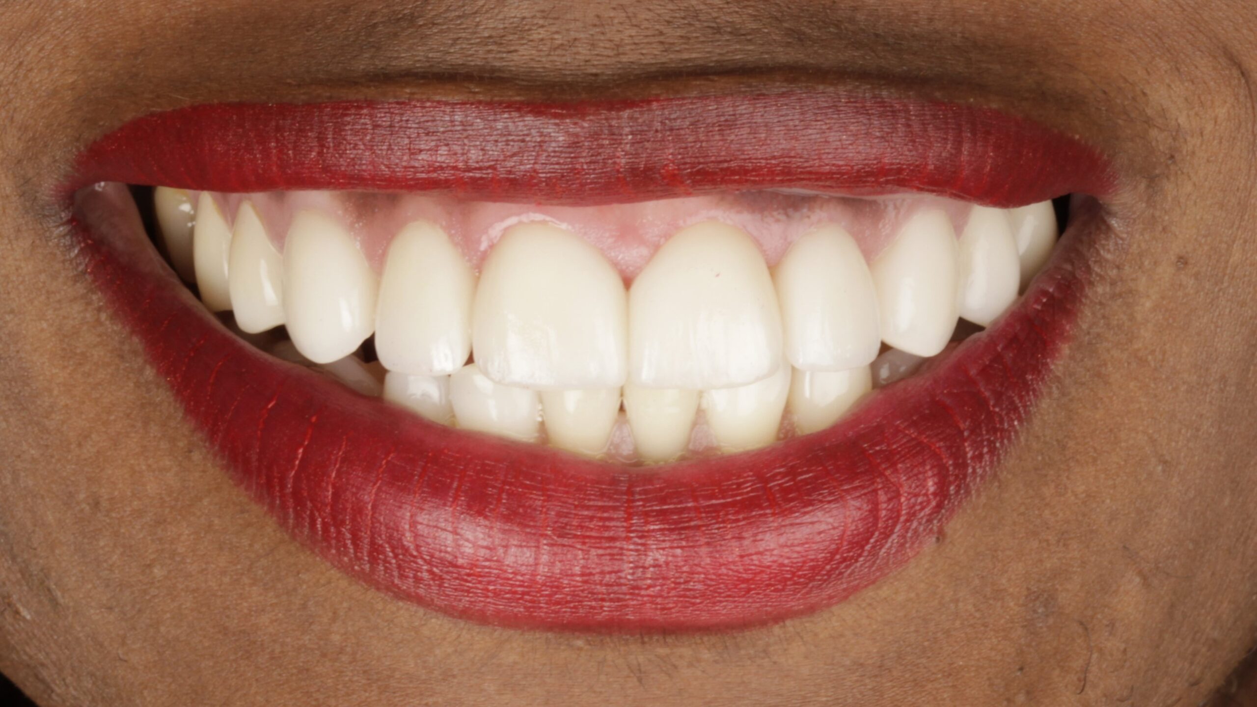 A bonded porcelain veneer case