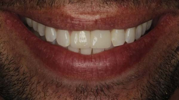After: full mouth reconstruction case 12
