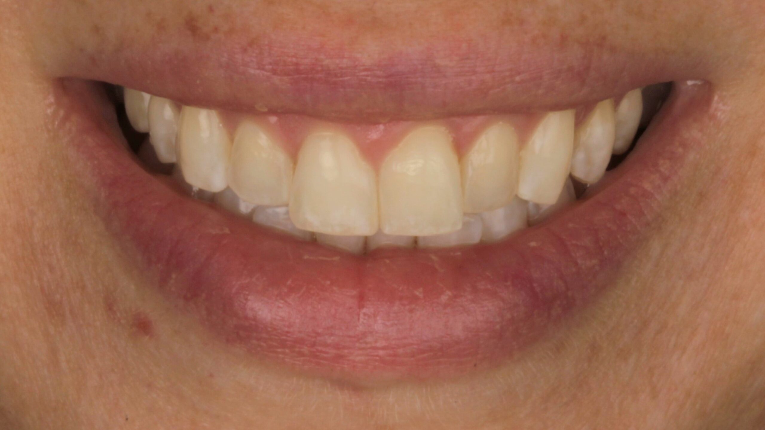Before: porcelain veneers case 40
