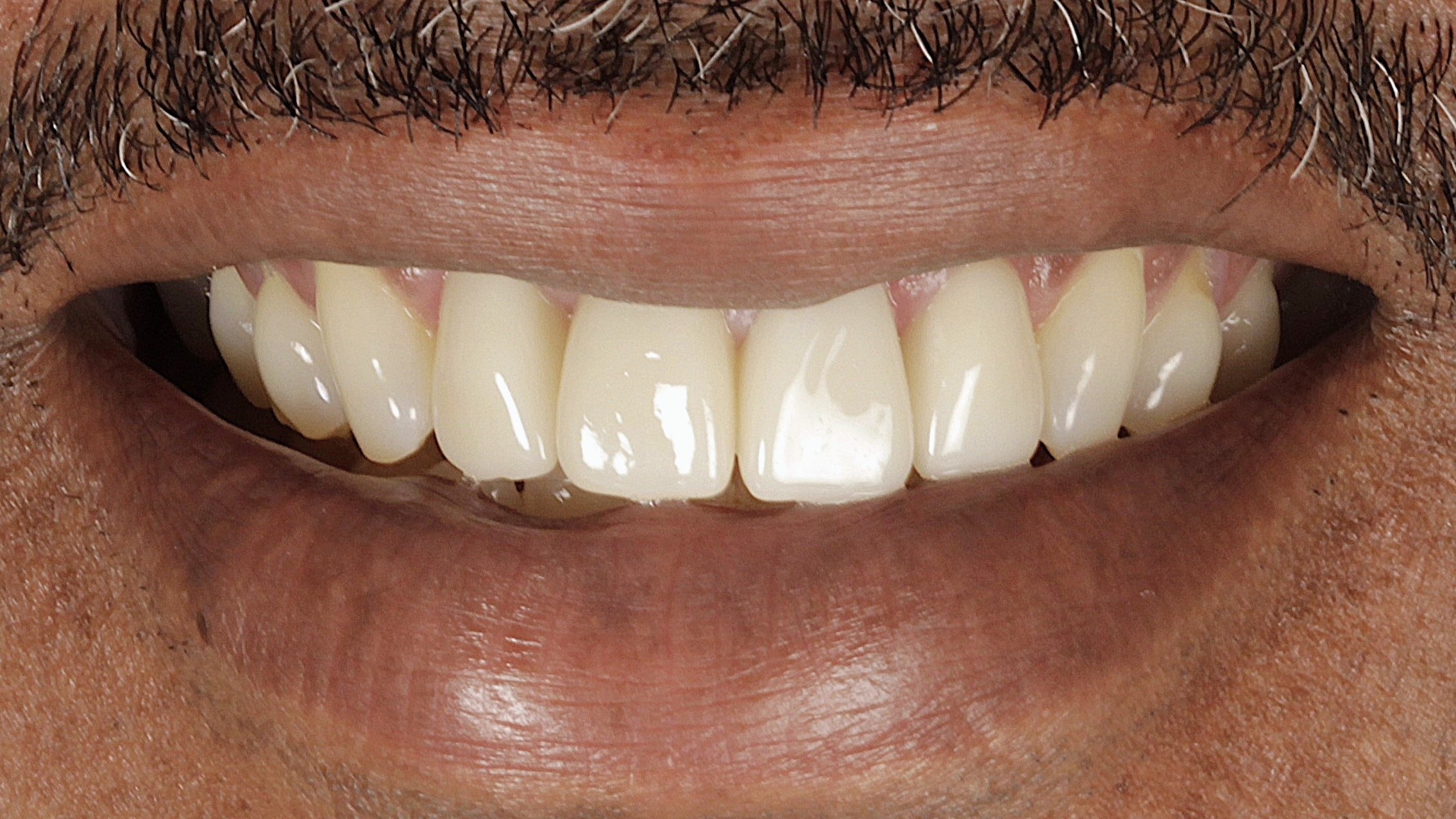 After: veneers + implants case 45