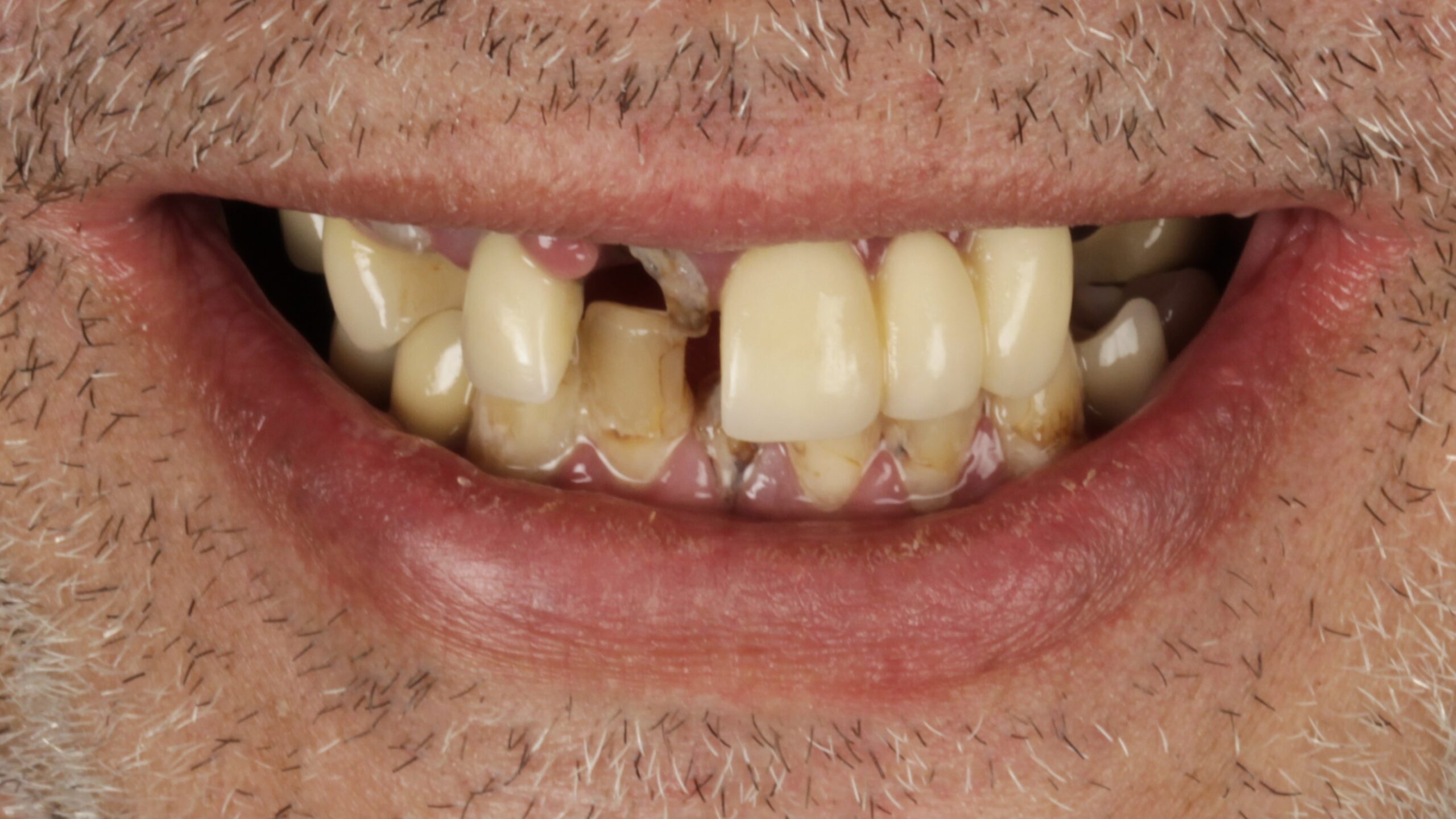 Before: double arch case 21