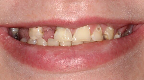 Before: all-on-4 case 10