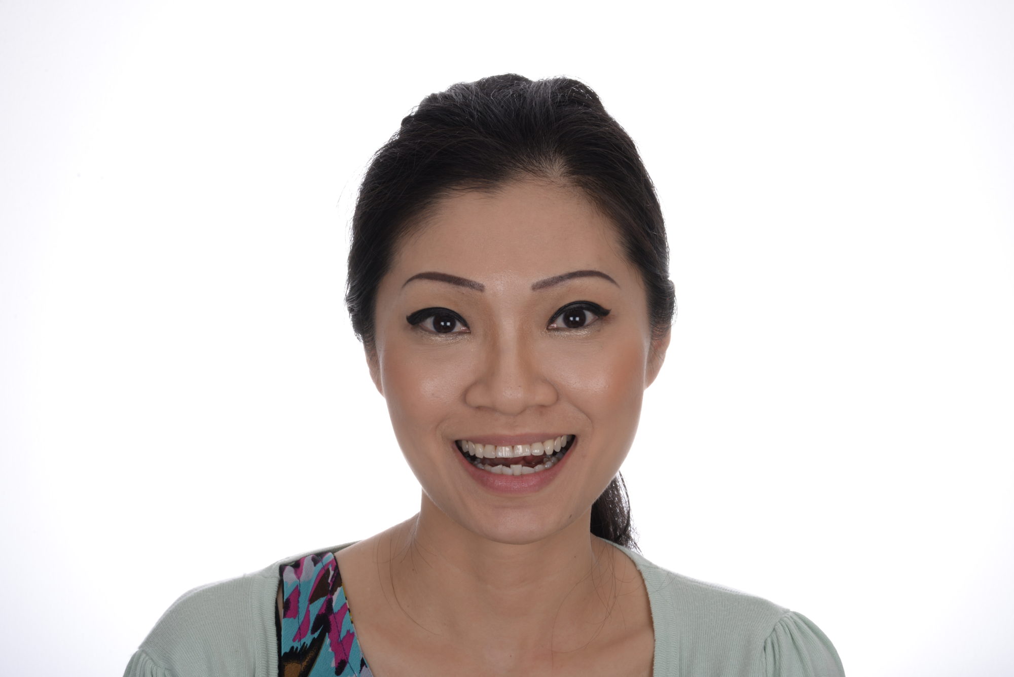 Before: smile makeover case 47