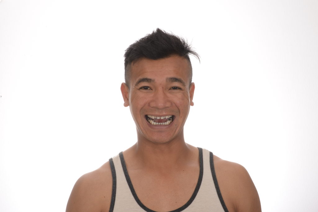 Before: smile makeover case 48