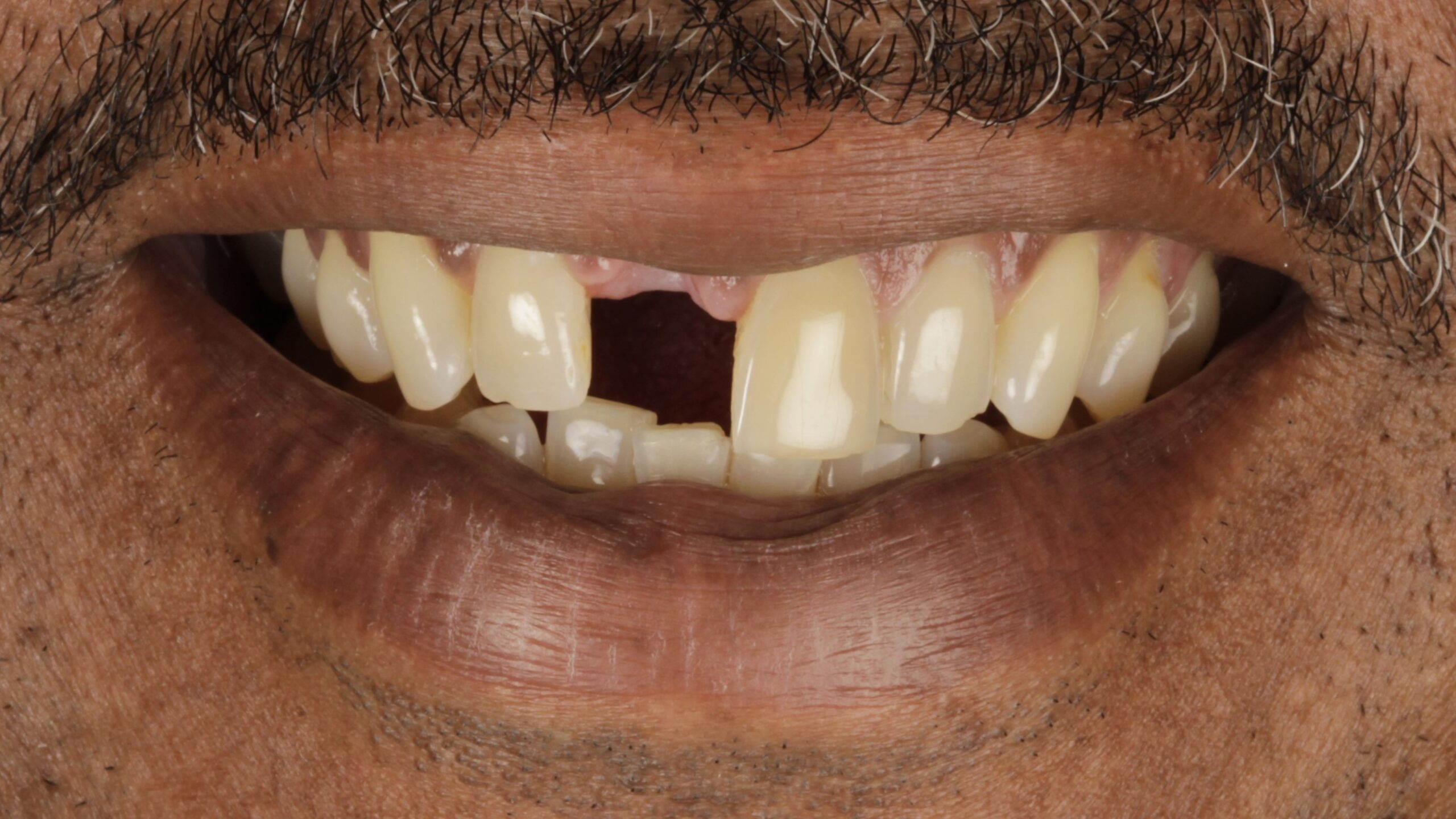 Before: veneers + implants case 45