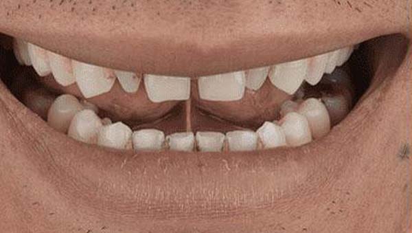 Before: porcelain veneers case 14