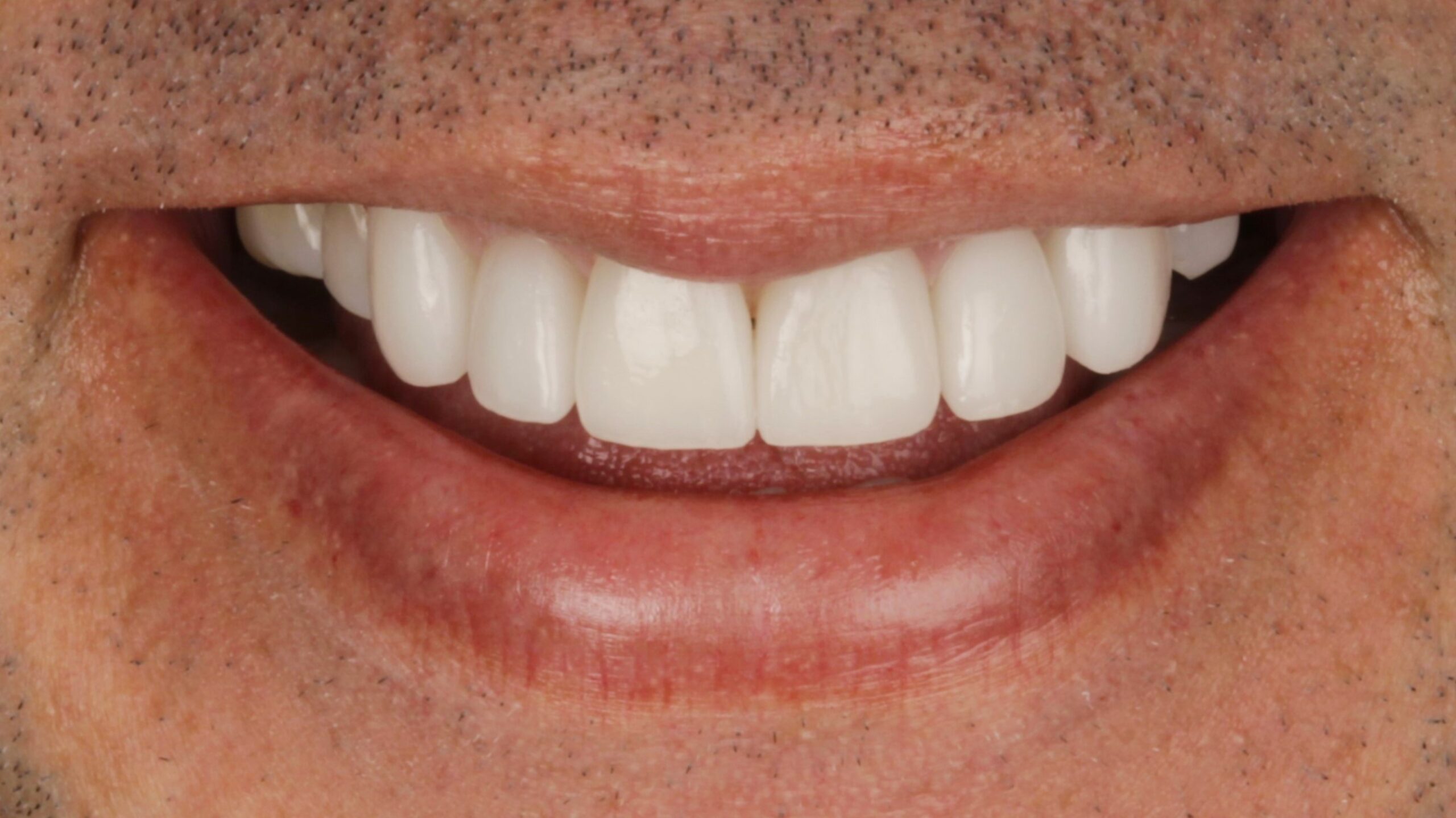 After: porcelain veneers case 37