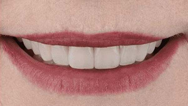 After: porcelain veneers case 18