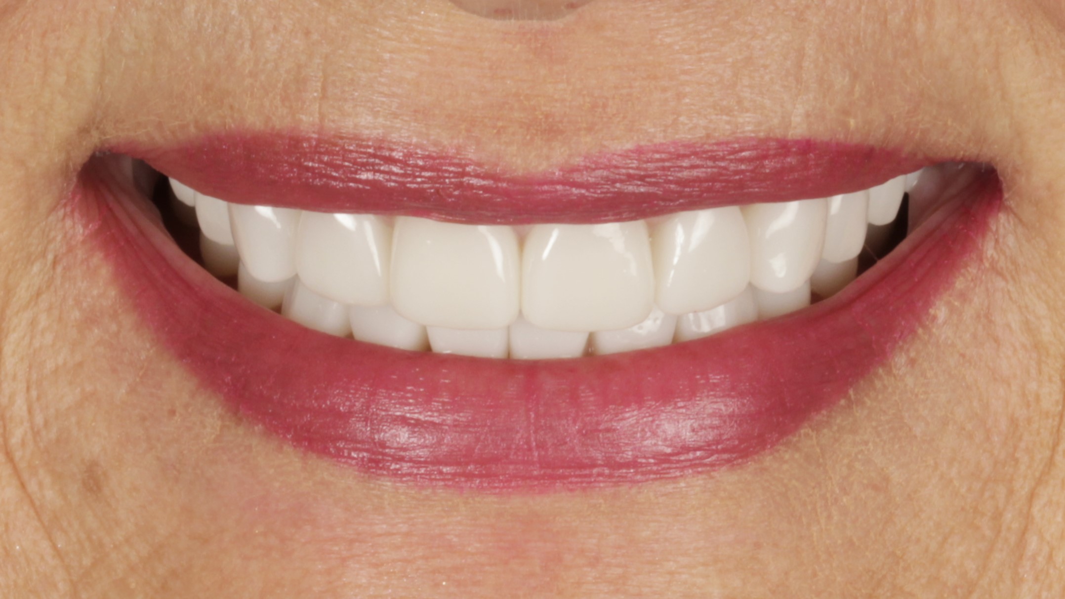 After: porcelain veneers case 34