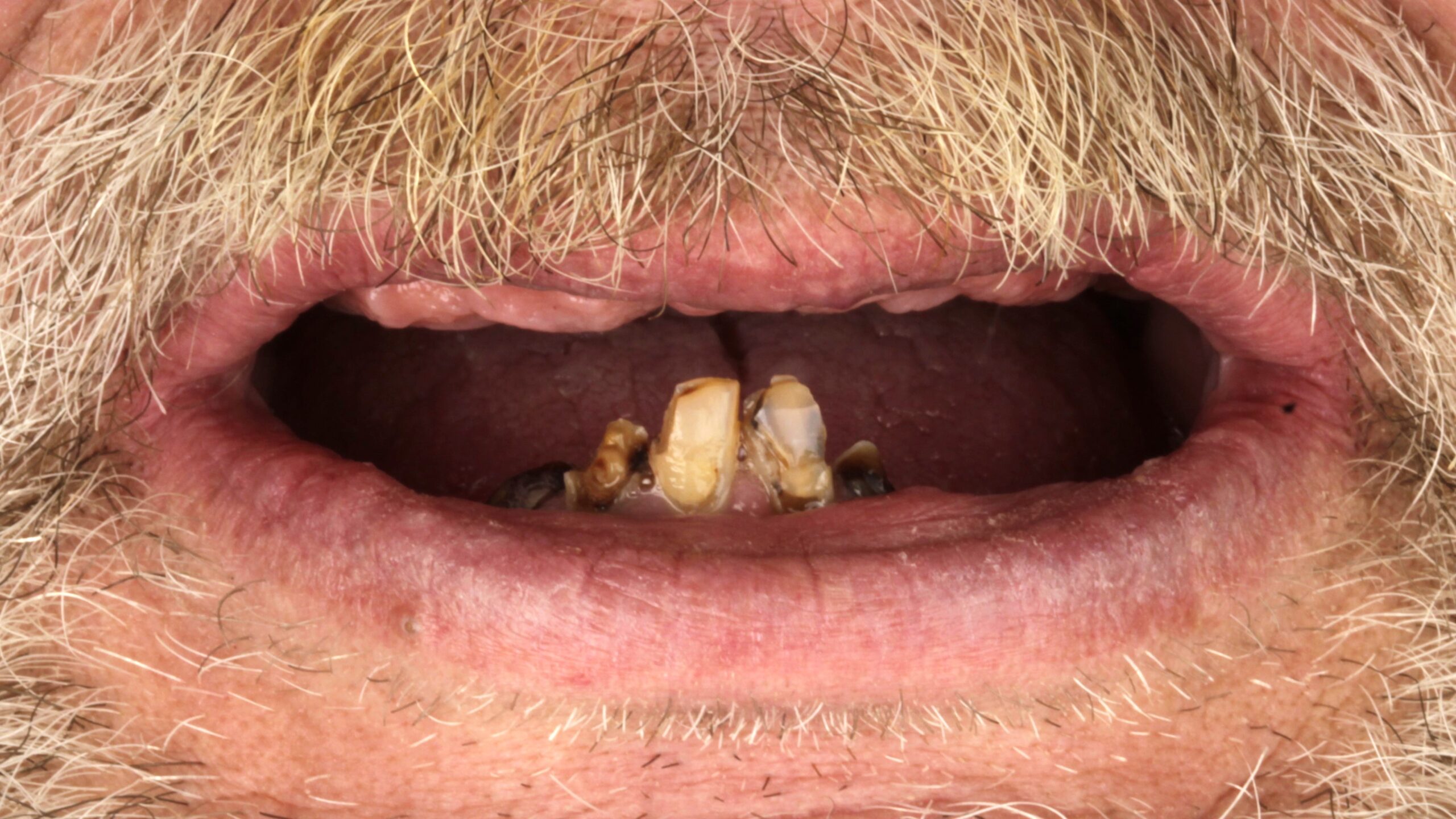 Before: double arch case 25