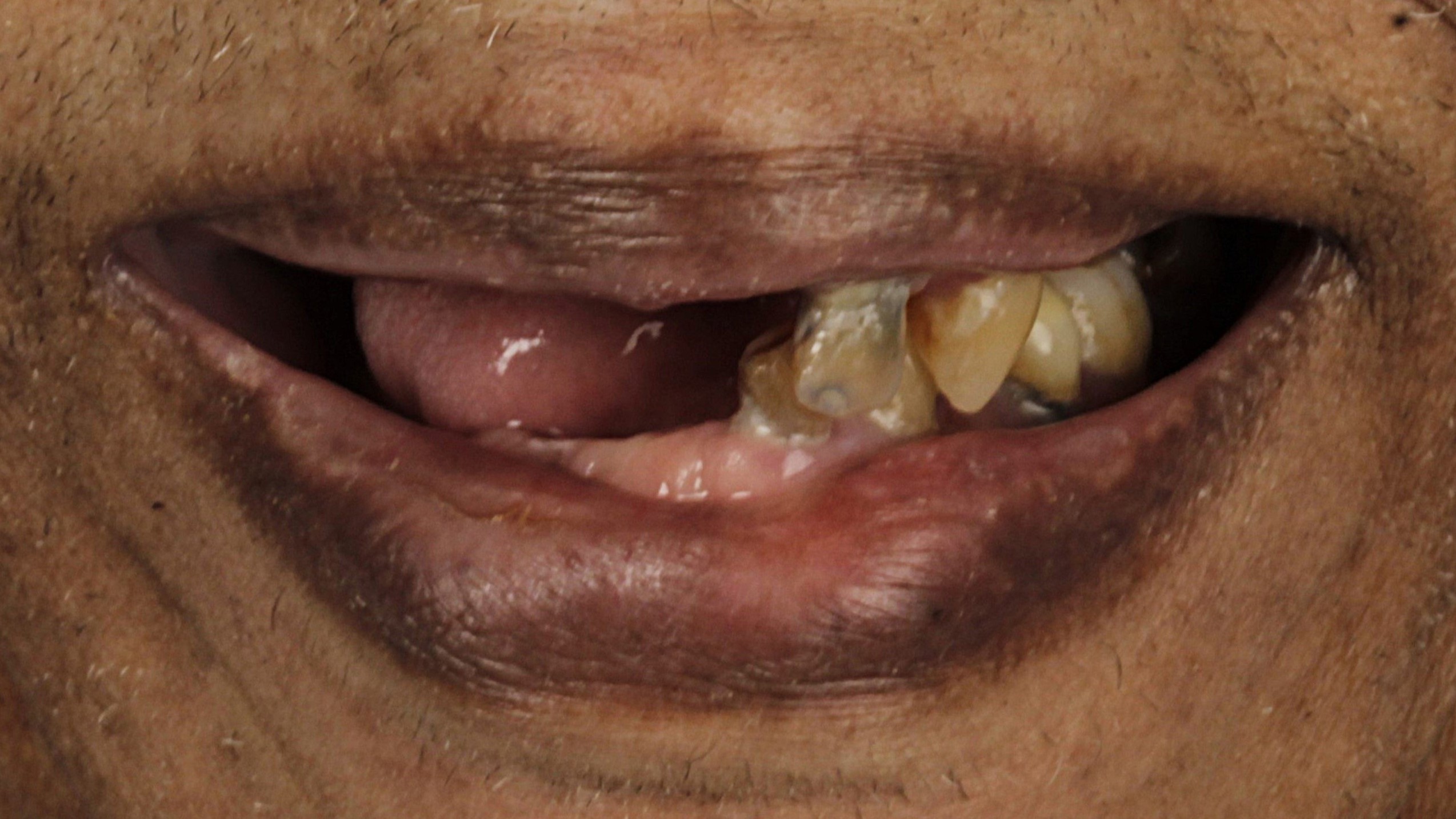 Before: full-mouth implant reconstruction