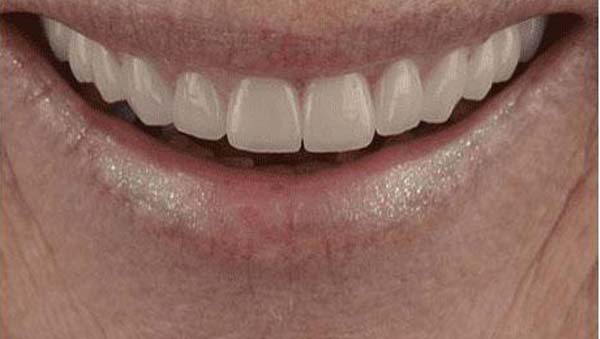 After: porcelain veneers case 19