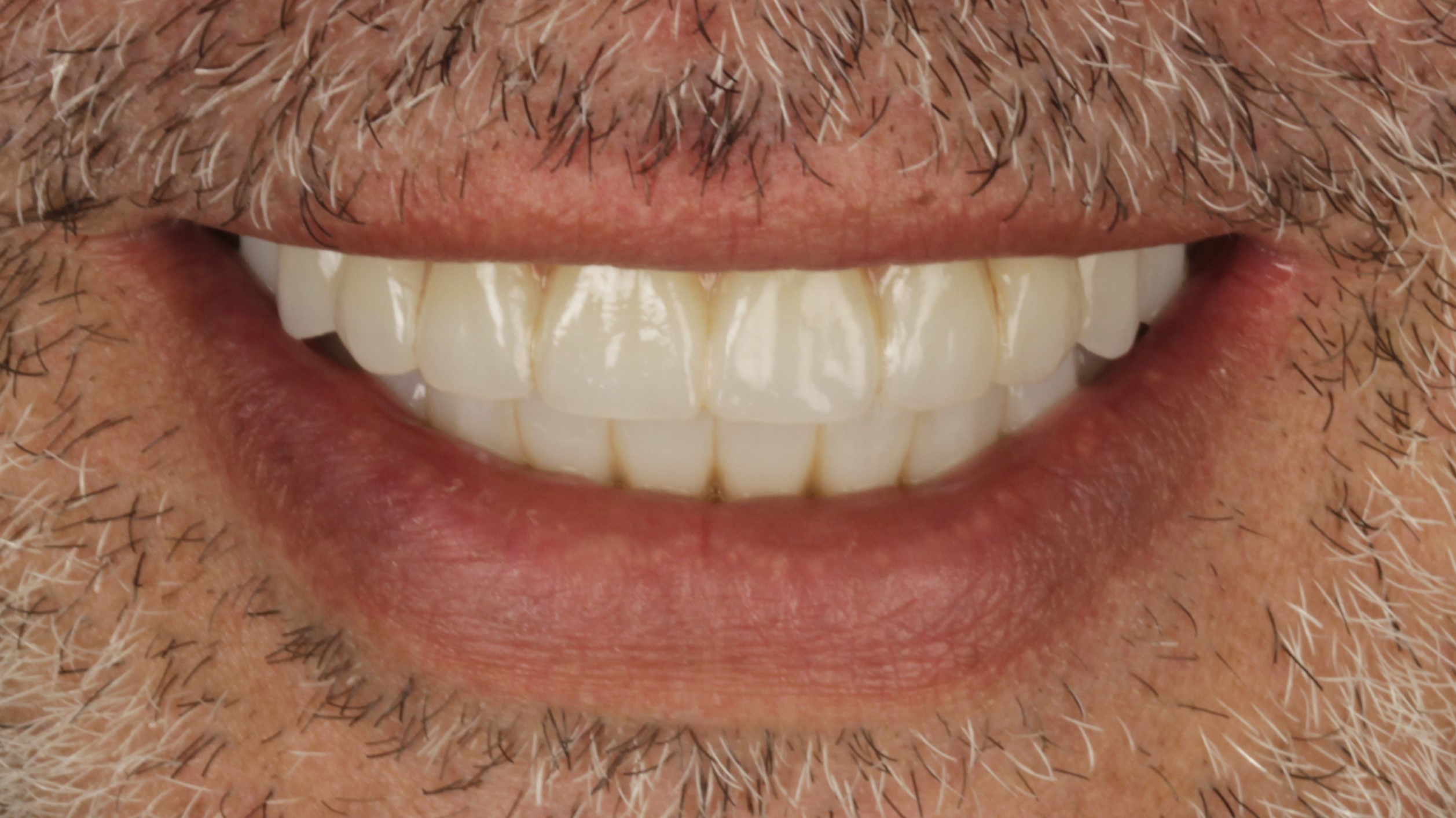 After: double arch case 21