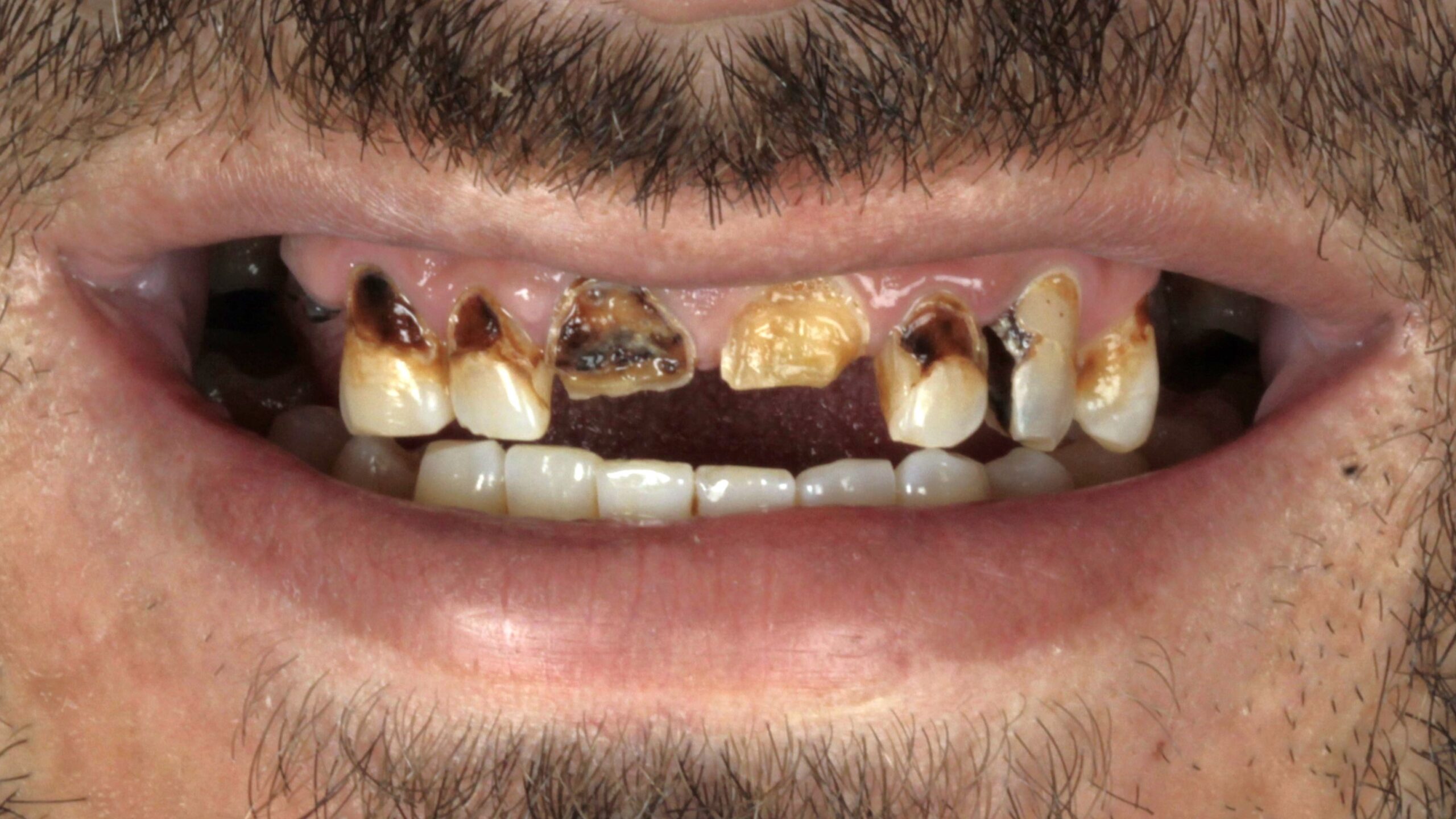 Before: single-arch implant restoration