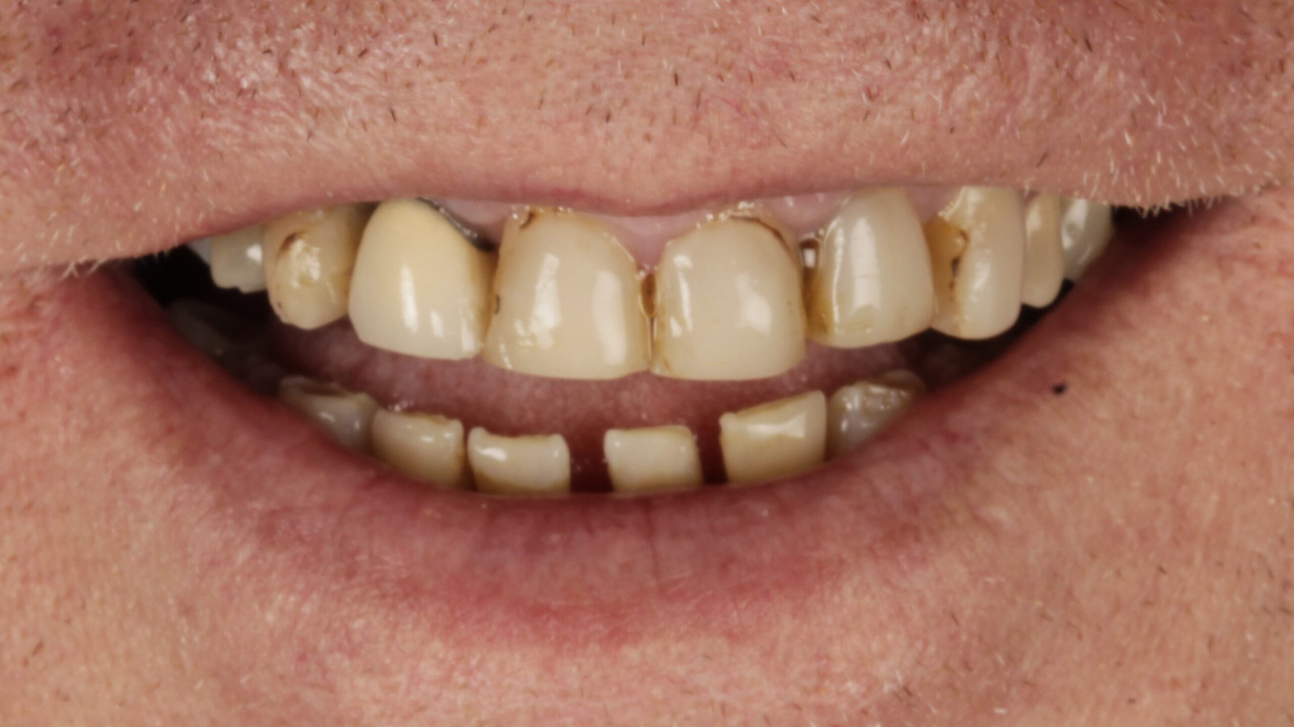 Before: double arch case 27
