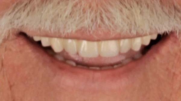 After: full mouth reconstruction case 8