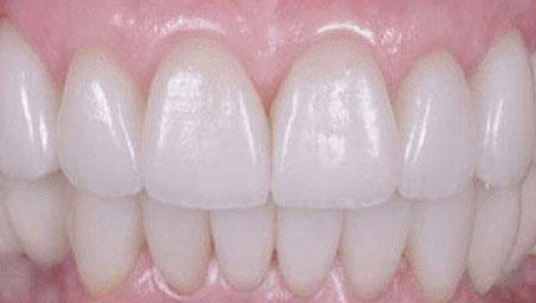 After: smile makeover case 16