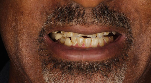 Before: failing and missing teeth