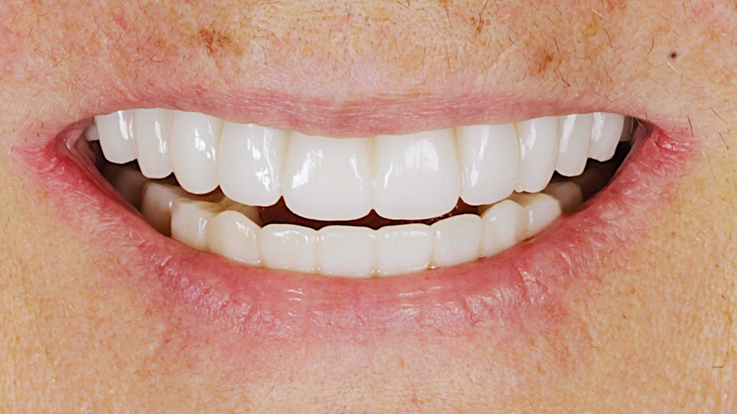 After: double arch case 24