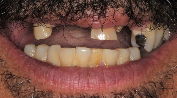 Before: all-on-4 case 2