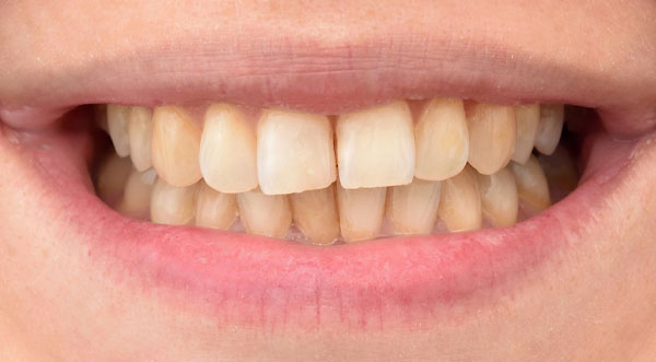 Stained natural teeth before whitening