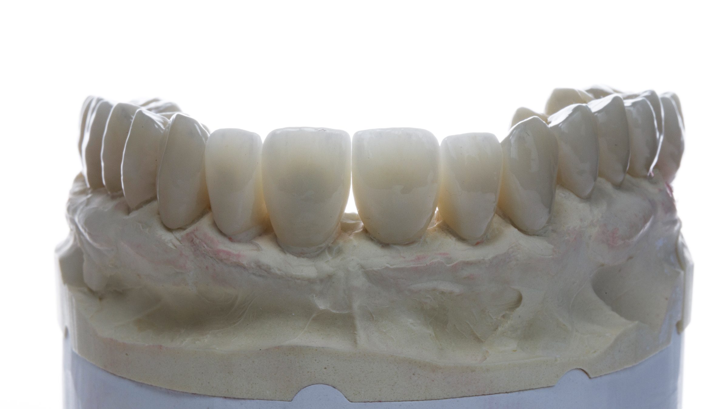 Set of lab-made porcelain veneers seated on a stone model of the patient's teeth
