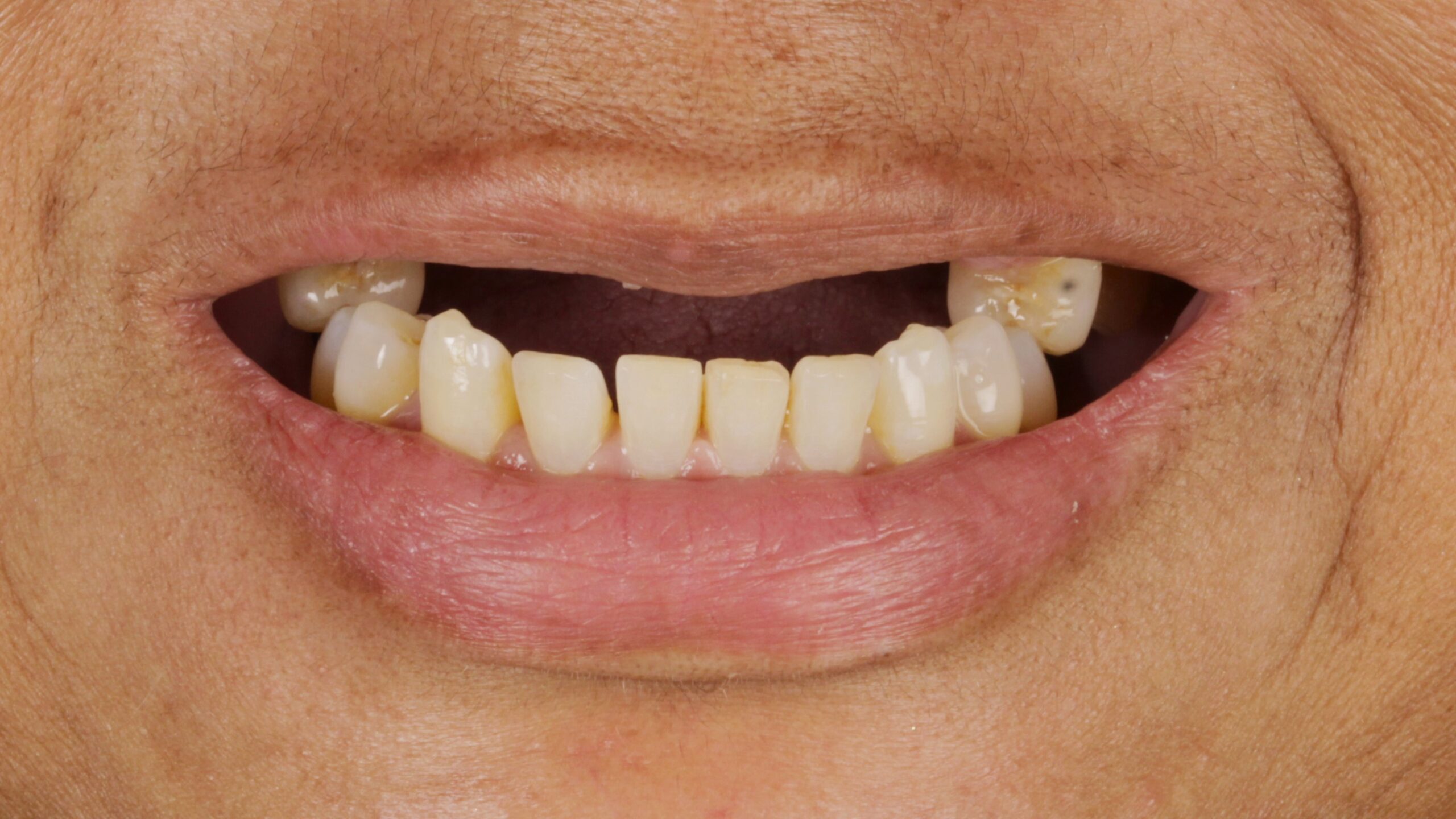Before: double arch case 22