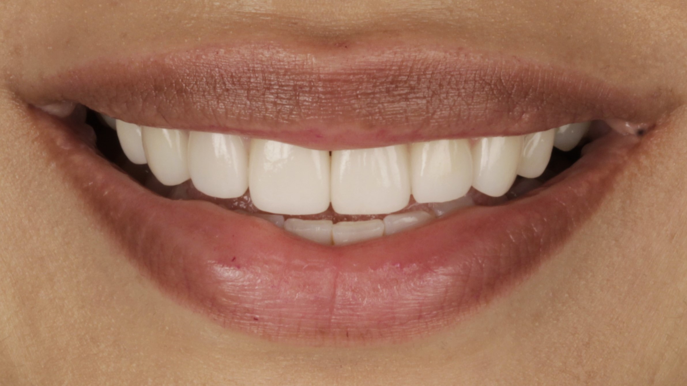 After: porcelain veneers case 39
