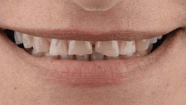 Before: porcelain veneers case 15