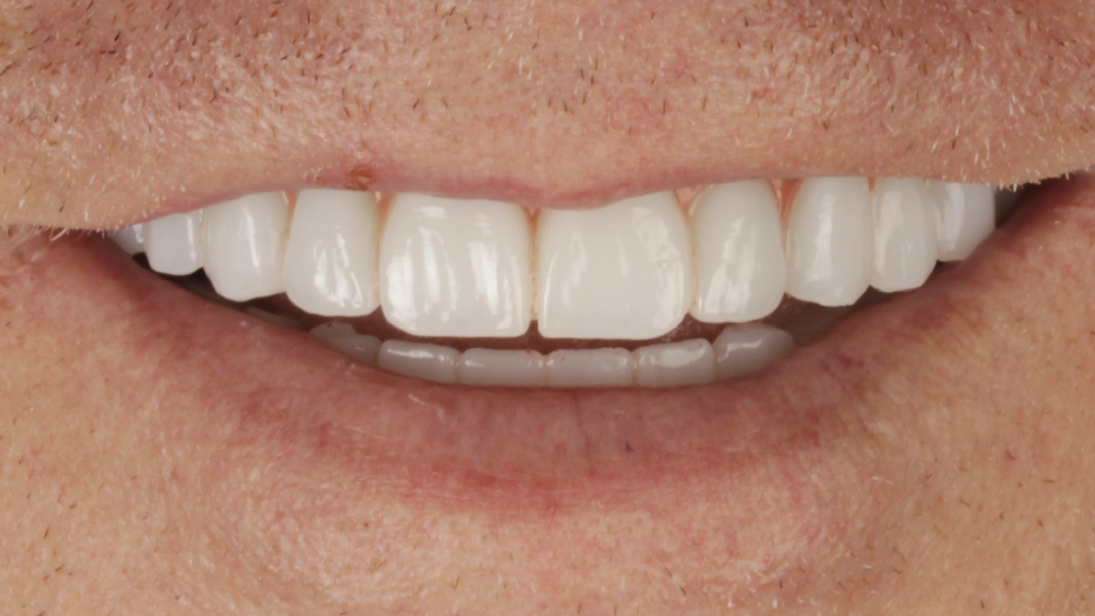 After: double arch case 27