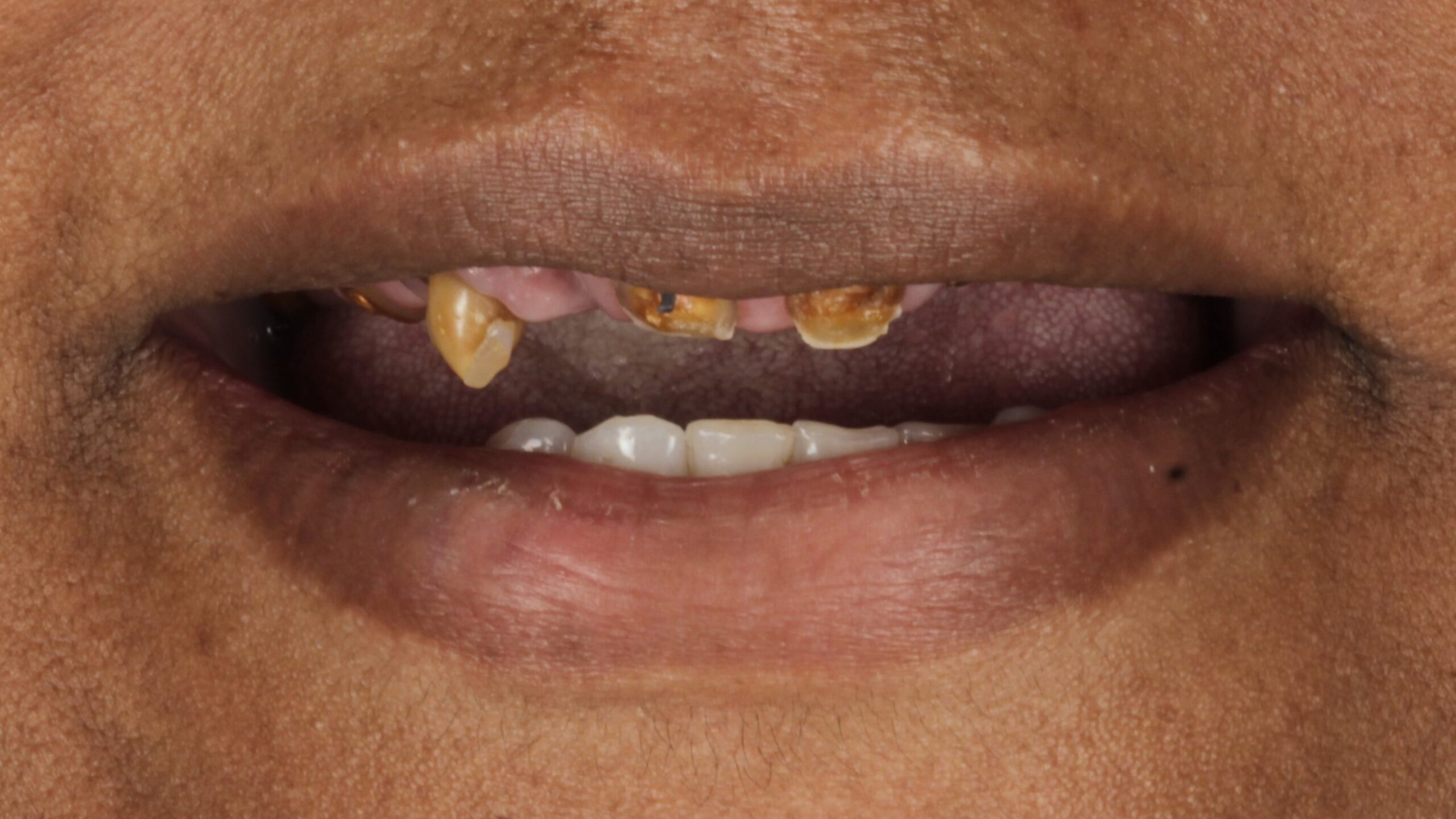 Before: single arch case 43