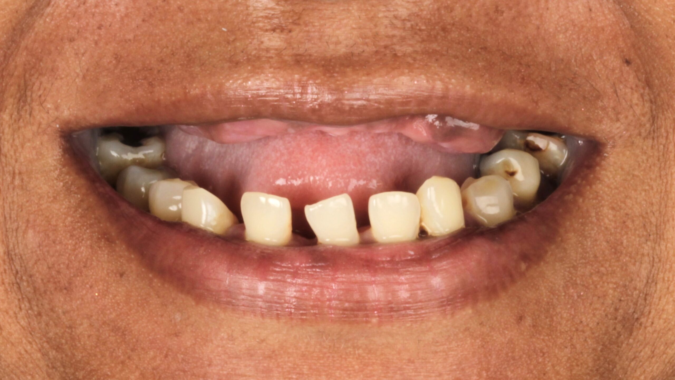 Before: double arch case 26