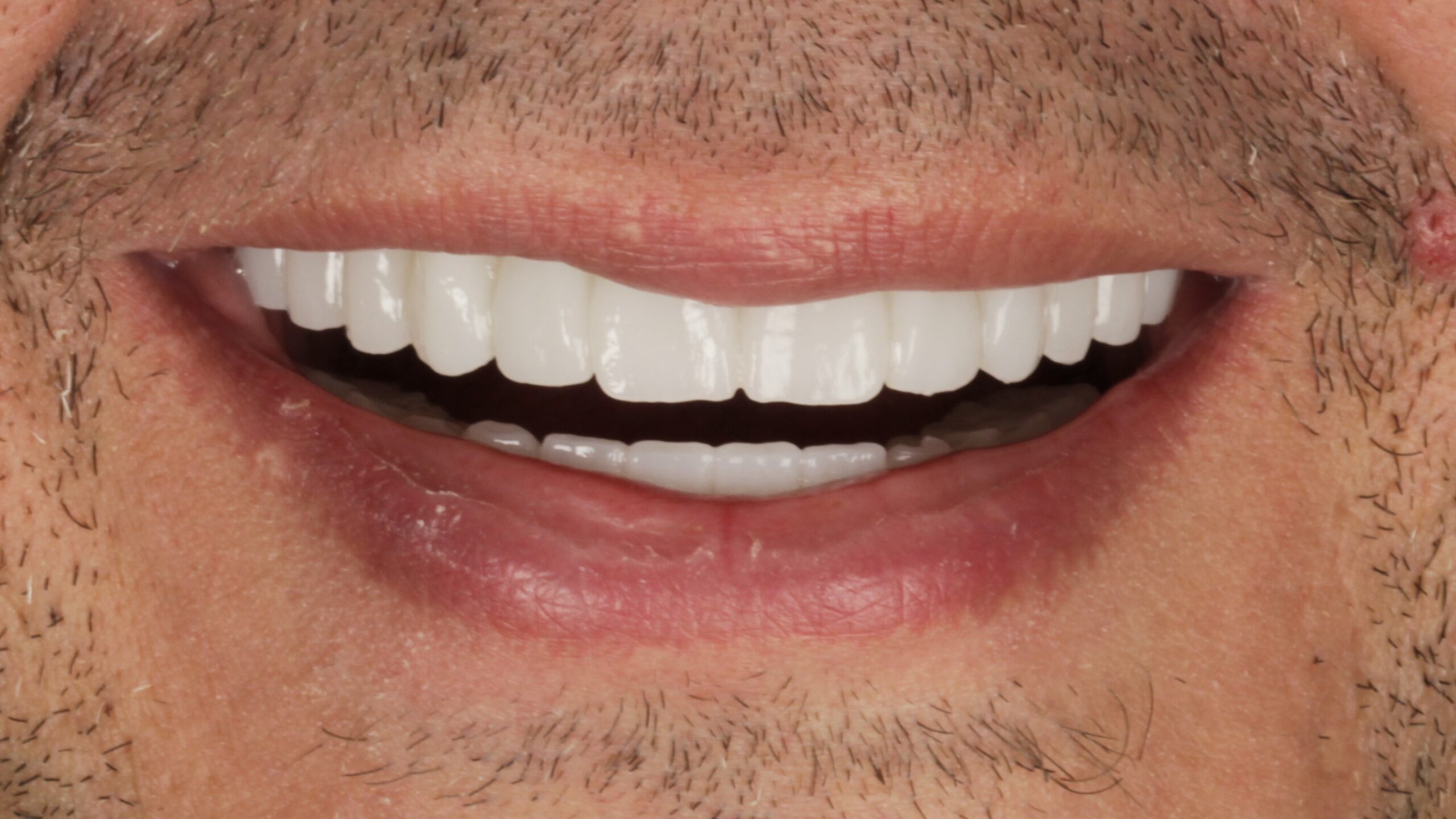 After: double arch case 46